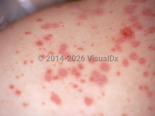 Clinical image of Vaccinia-induced erythema multiforme - imageId=1036141. Click to open in gallery.  caption: 'A close-up of erythematous papules, many targetoid.'