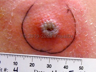 Clinical image of Vaccinia vaccination normal reaction - imageId=1106891. Click to open in gallery.  caption: 'An erythematous papule with a central crusted grayish pustule and surrounding erythema.'