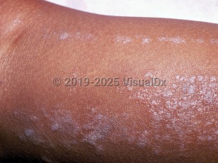 Clinical image of Lichen striatus - imageId=1234855. Click to open in gallery.  caption: 'Multiple violaceous scaly papules and plaques in a blaschkoid distribution on the calf.'