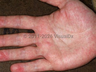 Papular-purpuric gloves and socks syndrome