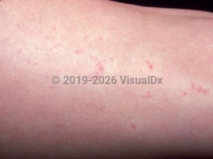 Clinical image of Unilateral nevoid telangiectasias - imageId=1554823. Click to open in gallery.  caption: 'Close-up of numerous red, telangiectatic macules and papules with surrounding haloes.'