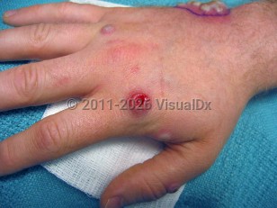 Clinical image of Mpox - imageId=1589825. Click to open in gallery.  caption: '2003 outbreak: Numerous large pustules, some single and some clustered, some crusted and one ulcerated, on the hand and thumb.'