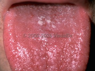 Clinical image of Oral candidiasis - imageId=176995. Click to open in gallery.  caption: 'Small, flat, white papules on the dorsal tongue.'