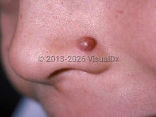 Clinical image of Pilomatricoma - imageId=179264. Click to open in gallery.  caption: 'A deep red papule with overlying telangiectasias on the nose.'