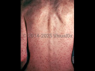 Clinical image of Colorado tick fever - imageId=1890149. Click to open in gallery.  caption: 'Widespread deeply erythematous macules and papules on the back and arms.'