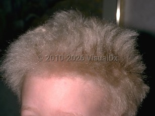 Clinical image of Uncombable hair syndrome - imageId=192443. Click to open in gallery.  caption: 'Unruly silver-blond hair with a spangled appearance. Many hairs are standing straight up from the scalp.'