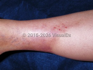 Clinical image of Lipodermatosclerosis - imageId=199728. Click to open in gallery.  caption: 'A depressed light brown and violaceous plaque of the lower leg, imparting a champagne-bottle-like appearance to the leg.'