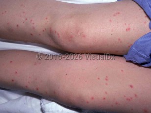 Clinical image of Trichosporon sepsis - imageId=2042393. Click to open in gallery.  caption: 'Multiple edematous deep pink papules scattered on the legs.'