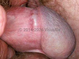 Clinical image of Sclerosing lymphangitis of the penis - imageId=2047232. Click to open in gallery.  caption: 'A shiny linear cord on the distal penis near the corona.'