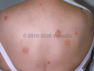 Nummular dermatitis
