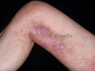 Clinical image of Drug-induced skin ulcers - imageId=2202445. Click to open in gallery.  caption: 'Crusted ulcers with surrounding pink and white scars on the leg, within prior psoriatic plaques (and surrounding postinflammatory pink macules and patches), secondary to methotrexate.'