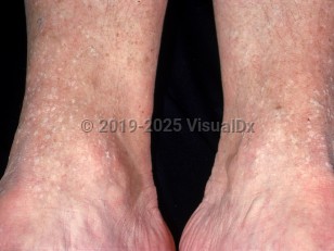 Clinical image of Acrokeratosis verruciformis - imageId=2225855. Click to open in gallery.  caption: 'Numerous discrete, hypopigmented, scaly papules around the ankles.'