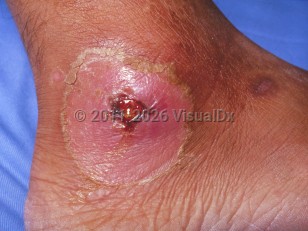 Clinical image of Cutaneous diphtheria - imageId=233476. Click to open in gallery.  caption: 'A pink plaque with a central superficial ulcer and a surrounding collarette of scale on the ankle.'