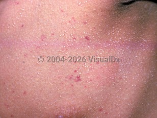 Clinical image of Miliaria crystallina - imageId=2346509. Click to open in gallery.  caption: 'A close-up of myriad tiny vesicles on the chest.'
