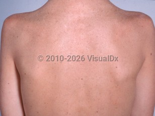 Clinical image of Cockayne syndrome - imageId=2364303. Click to open in gallery.  caption: 'Prematurely photoaged skin on the back.'