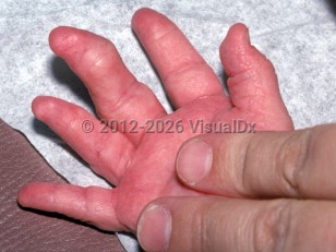 Clinical image of Proteus syndrome - imageId=2369560. Click to open in gallery. 