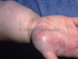 Clinical image of Lipoblastoma - imageId=2453572. Click to open in gallery.  caption: 'A palmar subcutaneous mass with overlying erythema and surgical scars. Note also the increased girth of the forearm.'
