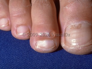 Clinical image of Myxoid cyst - imageId=272604. Click to open in gallery.  caption: 'A translucent papule on the distal toe.'