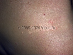 Clinical image of Primary biliary cholangitis - imageId=2755740. Click to open in gallery.  caption: 'A close-up of discrete and confluent yellow papules forming a patterned plaque (plane xanthomas).'