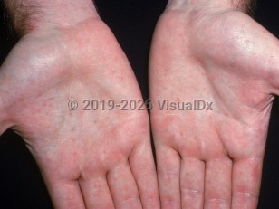 Clinical image of Basal cell nevus syndrome - imageId=2771016. Click to open in gallery.  caption: 'Numerous tiny pits on the palms.'