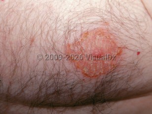 Clinical image of Nipple dermatitis - imageId=2792768. Click to open in gallery.  caption: 'A scaly and crusted plaque on the nipple and areola.'
