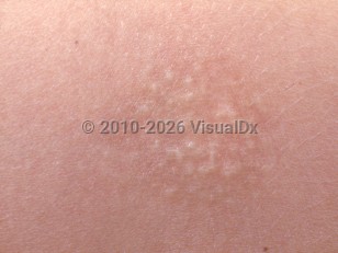 Clinical image of Alopecia mucinosa - imageId=2831863. Click to open in gallery.  caption: 'A close-up of a faint red-brown plaque displaying whitish follicularly-based papules.'