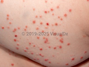 Pityriasis lichenoides et varioliformis acuta