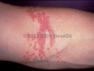 Clinical image of Lion's mane jellyfish sting - imageId=292160. Click to open in gallery.  caption: 'Edematous, erythematous papules and plaques in linear arrays at the antecubital fossa following a lion's mane jellyfish sting.'