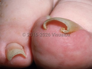 Clinical image of Pincer nail deformity - imageId=3018595. Click to open in gallery.  caption: 'Increased transverse curvature of the toenail, indenting the underlying skin.'