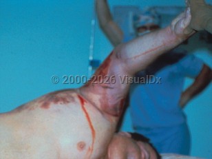 Clinical image of Gas gangrene - imageId=308081. Click to open in gallery.  caption: 'Extensive bluish discoloration of the arm (devitalized tissue) with secondary ulceration. Note also the retiform violaceous and maroon plaques on the lateral chest.'