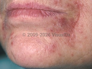 Clinical image of Periorificial dermatitis - imageId=326179. Click to open in gallery.  caption: 'Multiple tiny erythematous papules coalescing to form a plaque, with minimal scale at the oral commissure. Note the sparing of the lip margin.'