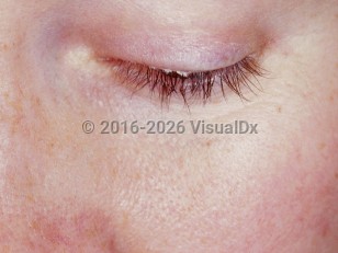 Seborrheic blepharitis