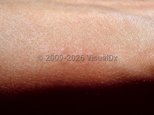 Clinical image of Puss caterpillar sting - imageId=3529419. Click to open in gallery.  caption: 'A linear array of edematous and faintly erythematous papules on the arm.'
