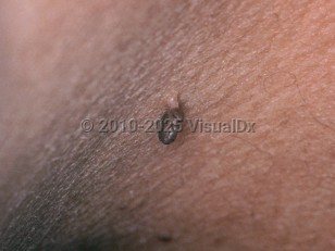 Clinical image of Acrochordon - imageId=3553735. Click to open in gallery.  caption: 'A close-up of a dark brown pedunculated papule.'