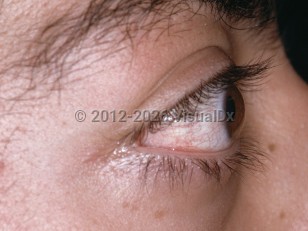 Clinical image of Proptosis - imageId=3567872. Click to open in gallery.  caption: 'A protruding globe.'