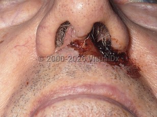 Clinical image of Trigeminal trophic syndrome - imageId=357852. Click to open in gallery.  caption: 'An ulcer with overlying and surrounding hemorrhagic crust at the nostril.'
