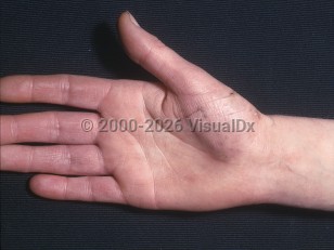 Clinical image of Acrocyanosis - imageId=367116. Click to open in gallery.  caption: 'A violaceous tinge to the fingers.'