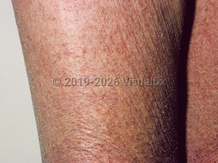 Clinical image of Acquired ichthyosis - imageId=37823. Click to open in gallery.  caption: 'Diffuse xerosis and fine adherent scales on the legs of a patient with lymphoma.'
