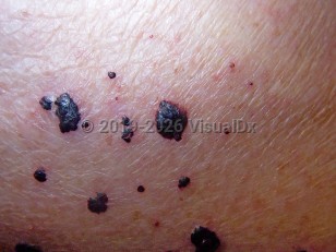 Clinical image of Bullous hemorrhagic dermatosis - imageId=3791721. Click to open in gallery.  caption: 'A close-up of numerous hemorrhagic vesicles and bullae, and early crusting, in a patient on an anticoagulant.'