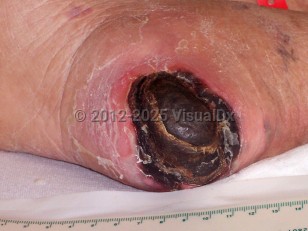 Clinical image of Unstageable pressure injury - imageId=3969180. Click to open in gallery.  caption: 'A deep ulcer covered by a thick eschar on the heel.'