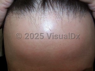 Clinical image of Frontal fibrosing alopecia - imageId=4055699. Click to open in gallery.  caption: 'A band of scarring alopecia at the anterior scalp line with few remaining hairs in scarred areas (the "lonely hair" sign). There is significant perifollicular scale and some erythema on the scalp posterior to this band.'