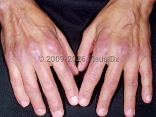 Rheumatoid arthritis