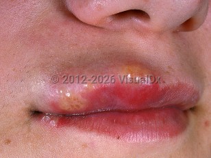 Orofacial herpes simplex virus