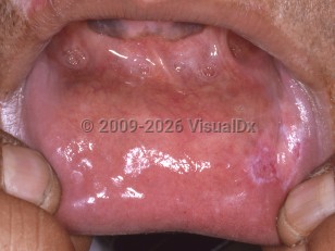 Clinical image of Oral lupus erythematosus - imageId=4347200. Click to open in gallery.  caption: 'Whitish and reddish plaques on the labial mucosa.'