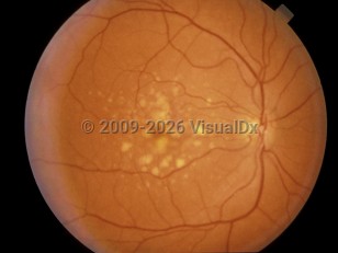 Ophthalmic Imaging image of Age-related macular degeneration - imageId=4378880. Click to open in gallery. 