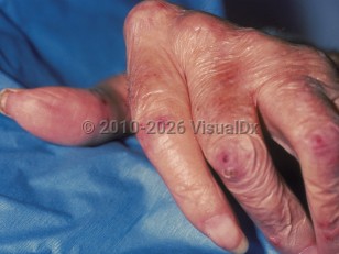 Rheumatoid vasculitis