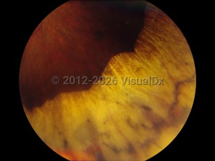 Ophthalmic Imaging image of Retinopathy of prematurity - imageId=4538015. Click to open in gallery. 