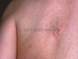 Clinical image of Fibrous hamartoma of infancy - imageId=457780. Click to open in gallery.  caption: 'A hypertrichotic patch on the back. Note also the unrelated erythematous papules (possible miliaria rubra).'