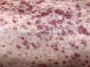 Clinical image of Multiple myeloma - imageId=4607088. Click to open in gallery.  caption: 'A close-up of multiple violaceous macules and papules.'