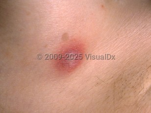 Clinical image of Ecthyma gangrenosum - imageId=47238. Click to open in gallery.  caption: 'A close-up of an erythematous plaque with a central overlying bulla.'